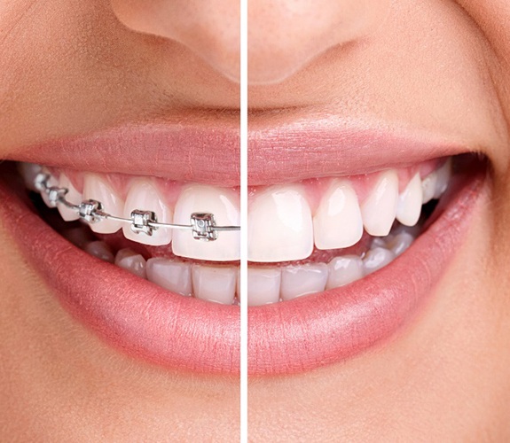 Clear Braces for Adults Are Ideal for Anyone Getting Married - Henry  Orthodontics Laurinburg, North Carolina