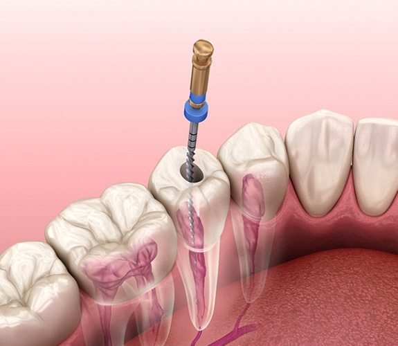 Illustration of pulp therapy being performed on the tooth